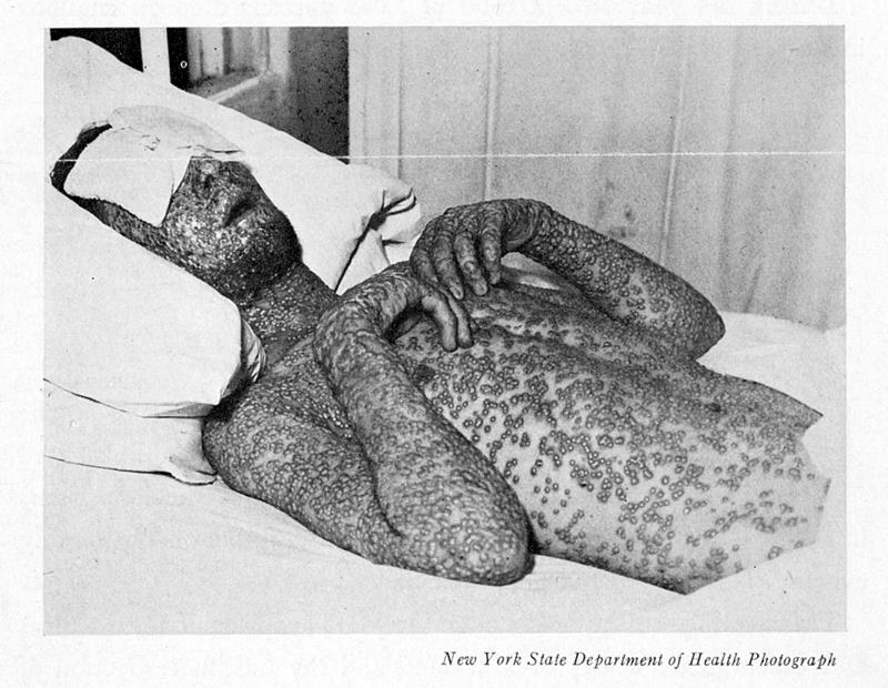 A victim of smallpox lies in a hospital bed.