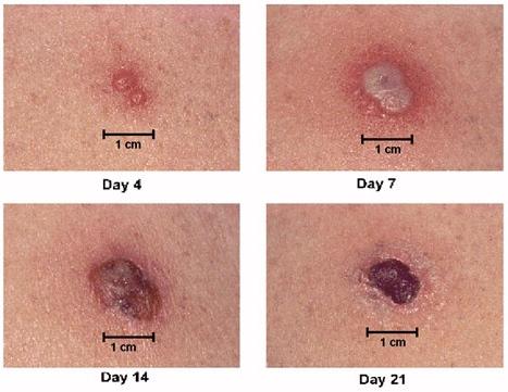 <img typeof="foaf:Image" src="http://statelibrarync.org/learnnc/sites/default/files/images/vaccinereaction.jpg" width="467" height="361" alt="Smallpox primary vaccine site reaction" title="Smallpox primary vaccine site reaction" />